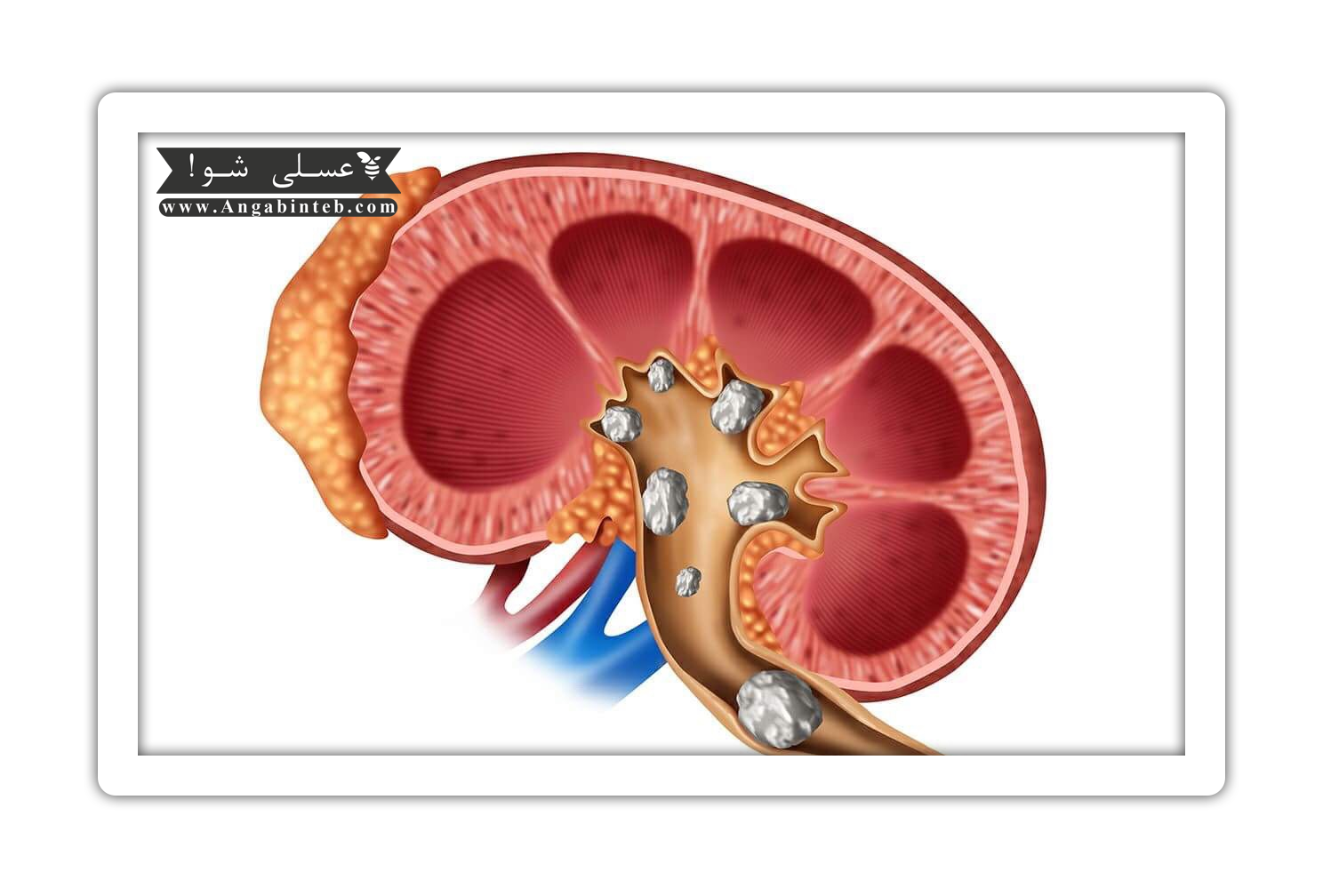 Tea consumption in kidney stone disease-7.png